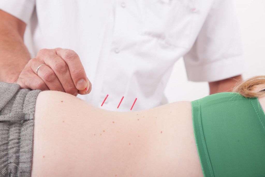 Acupunctuur bij ischias